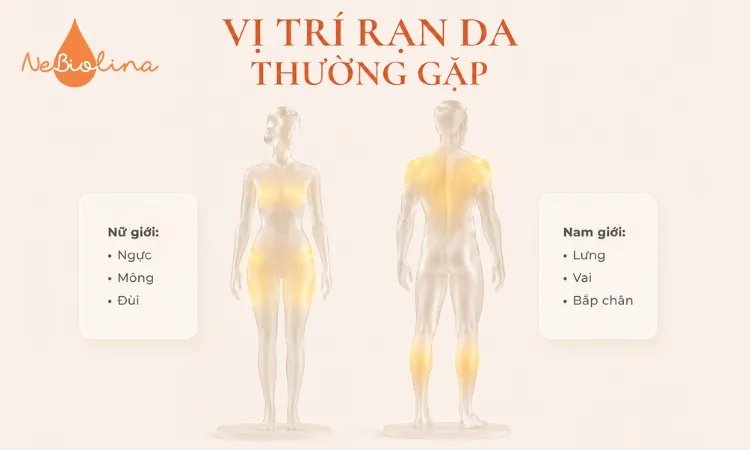 Rạn da tuổi dậy thì có thể xảy ra ở cả nam và nữ tại những vị trí khác nhau