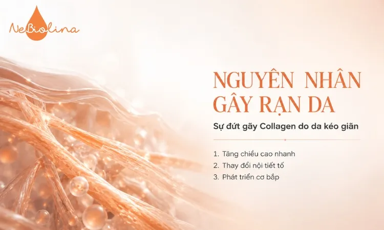 Rạn da do da không kịp thích nghi với những thay đổi nhanh chóng của cơ thể