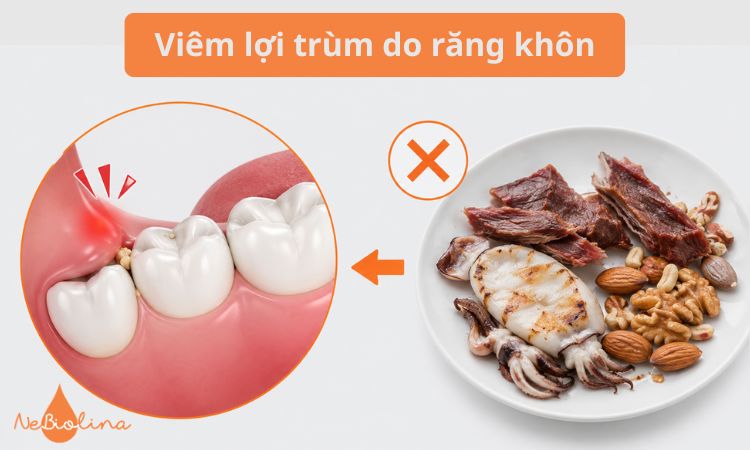 Thức ăn dai dễ mắc dưới lợi trùm, làm viêm nặng hơn.