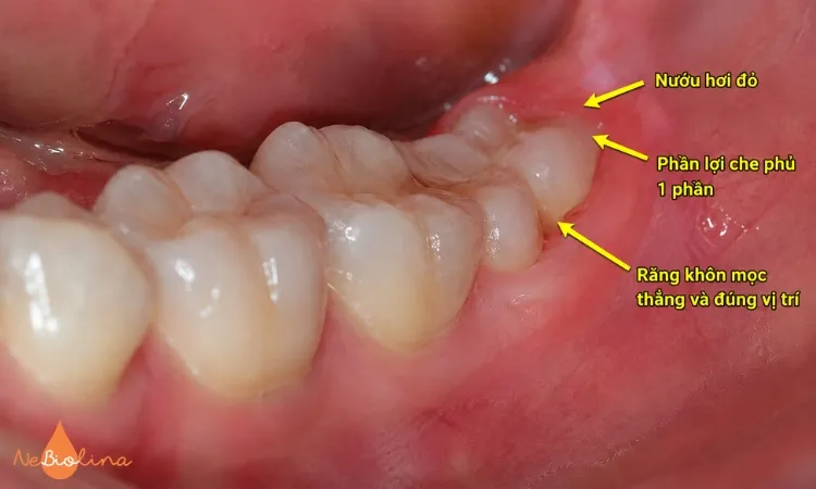 Viêm lợi trùm tự cải thiện khi quá trình mọc răng diễn ra thuận lợi. 
