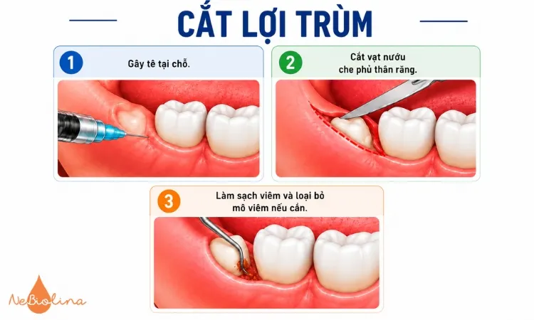 Cắt lợi trùm phù hợp cho viêm nhẹ - trung bình.
