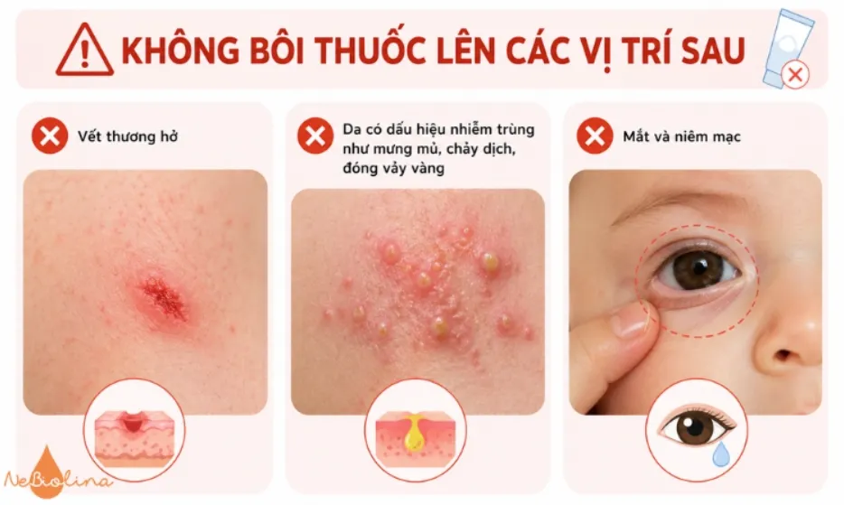 Bôi thuốc đúng vị trí để tránh tác dụng phụ.