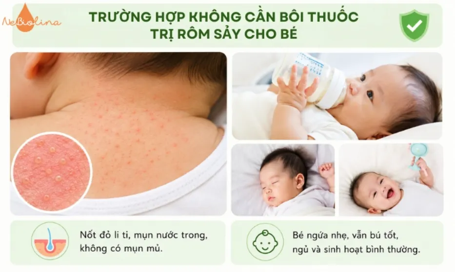Không phải lúc nào cũng có thể dùng thuốc trị rôm sảy cho bé.