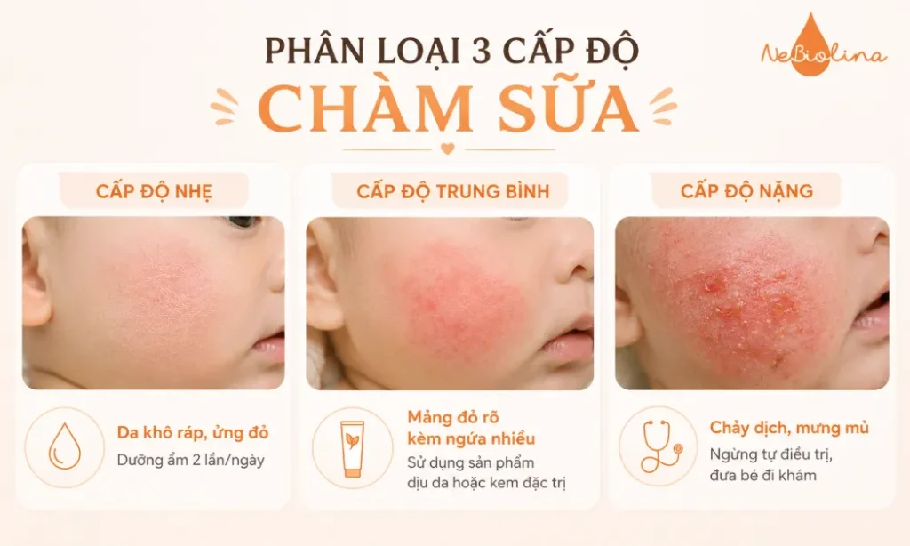 Tùy vào mức độ chàm sữa có cách xử lý khác nhau