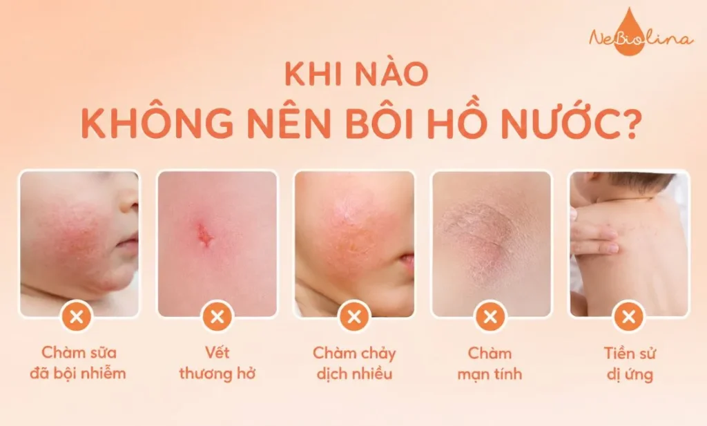 Những trường hợp không nên bôi hồ nước khi bị chàm sữa