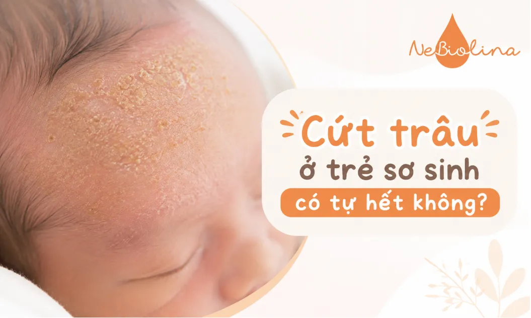 Phần lớn trường hợp cứt trâu ở trẻ sơ sinh đều tự hết