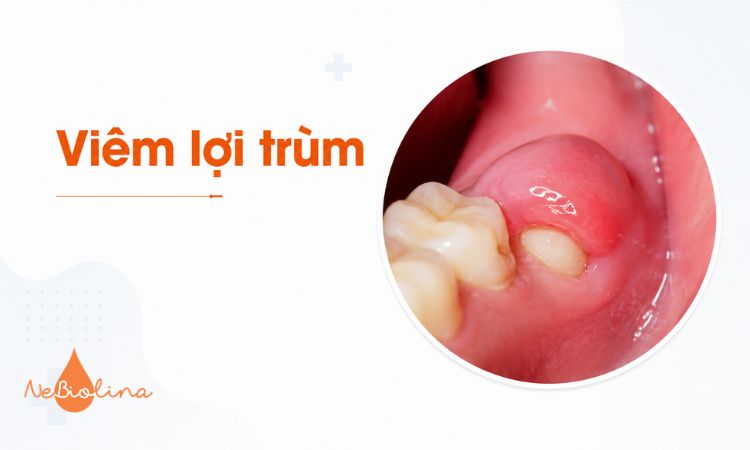 Viêm lợi trùm thường xảy ra quanh răng khôn đang mọc.