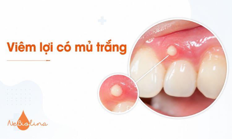 Viêm lợi có mủ trắng là dấu hiệu nhiễm trùng cần điều trị sớm.