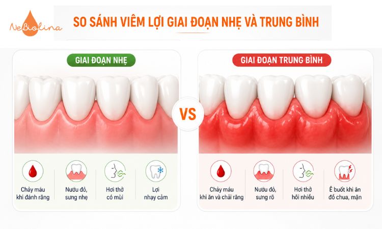So sánh dấu hiệu viêm lợi giai đoạn nhẹ và giai đoạn trung bình.