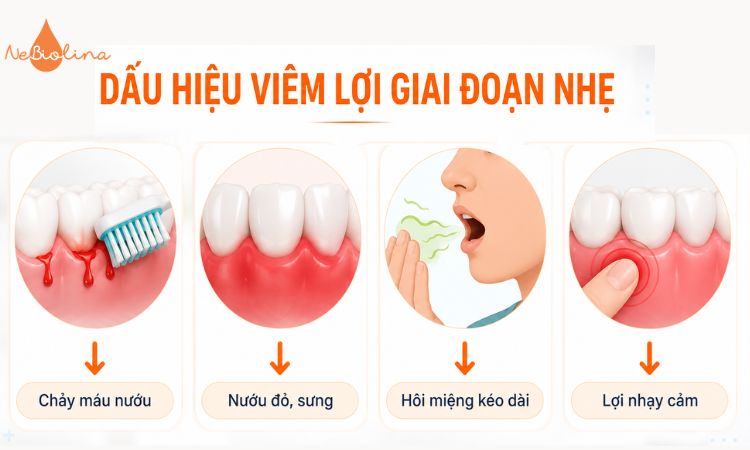 Dấu hiệu viêm lợi giai đoạn nhẹ với các triệu chứng điển hình.