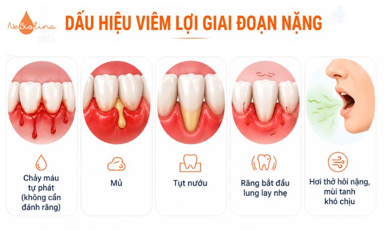 Dấu hiệu của viêm lợi giai đoạn nặng