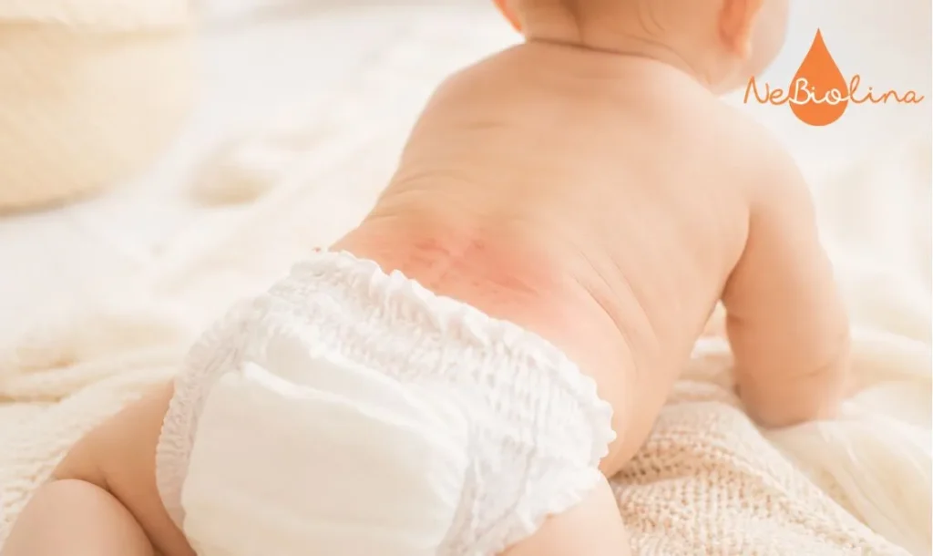Một trong những nguyên nhân chính gây hăm tã ở trẻ là do môi trường tã
