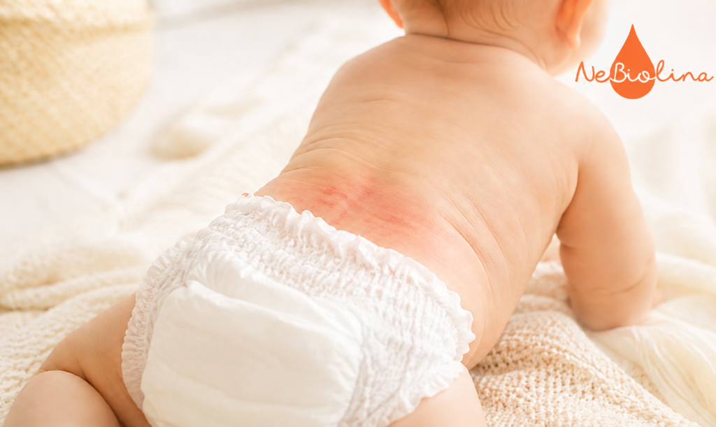 Một trong những nguyên nhân chính gây hăm tã ở trẻ là do môi trường tã