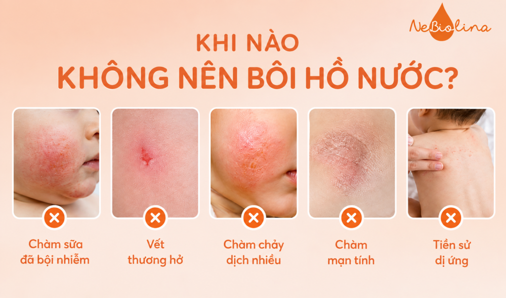 Những trường hợp không nên bôi hồ nước khi bị chàm sữa