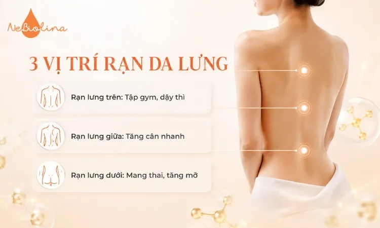 Mỗi vị trí rạn da phản ánh nguyên nhân khác nhau