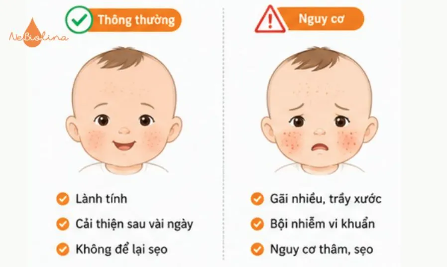 Rôm sảy ở mặt có nguy hiểm không?