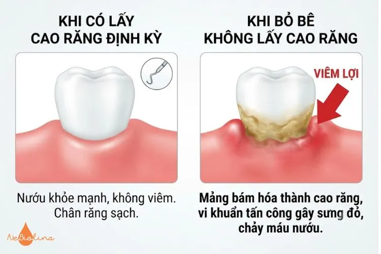 Không lấy cao răng định kỳ có thể gây viêm lợi