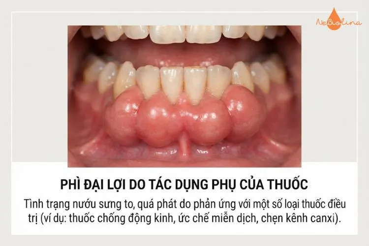 Phì đại lợi do tác dụng phụ của thuốc