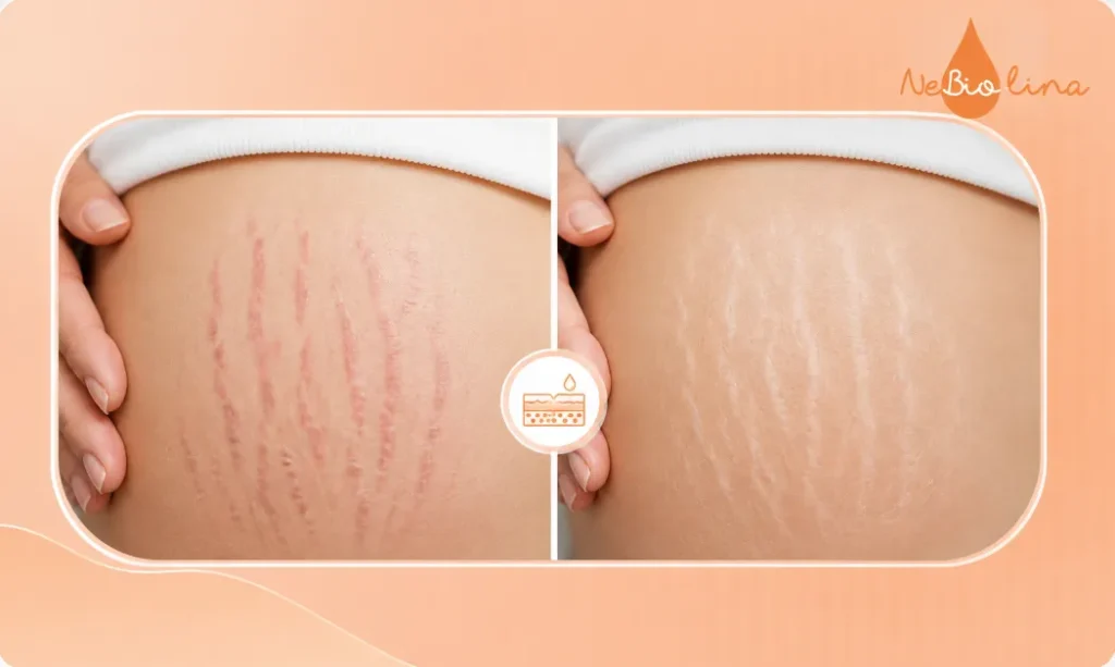 Về cơ bản, rạn da là một dạng sẹo teo da