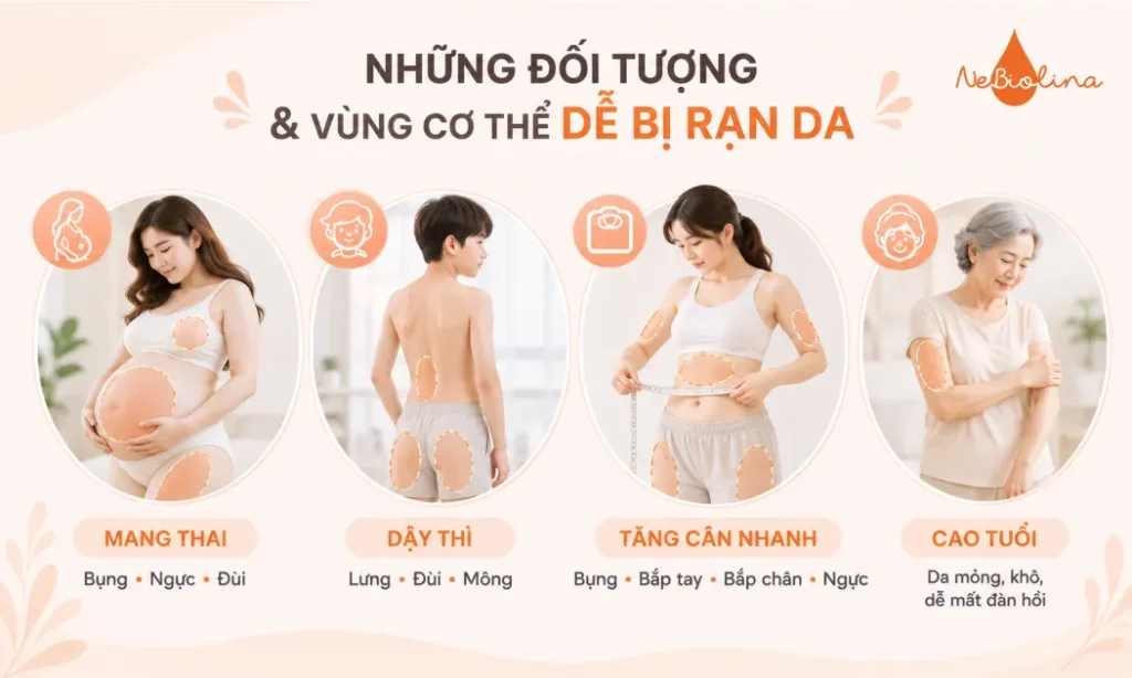 Những đối tượng và vùng cơ thể dễ bị rạn da