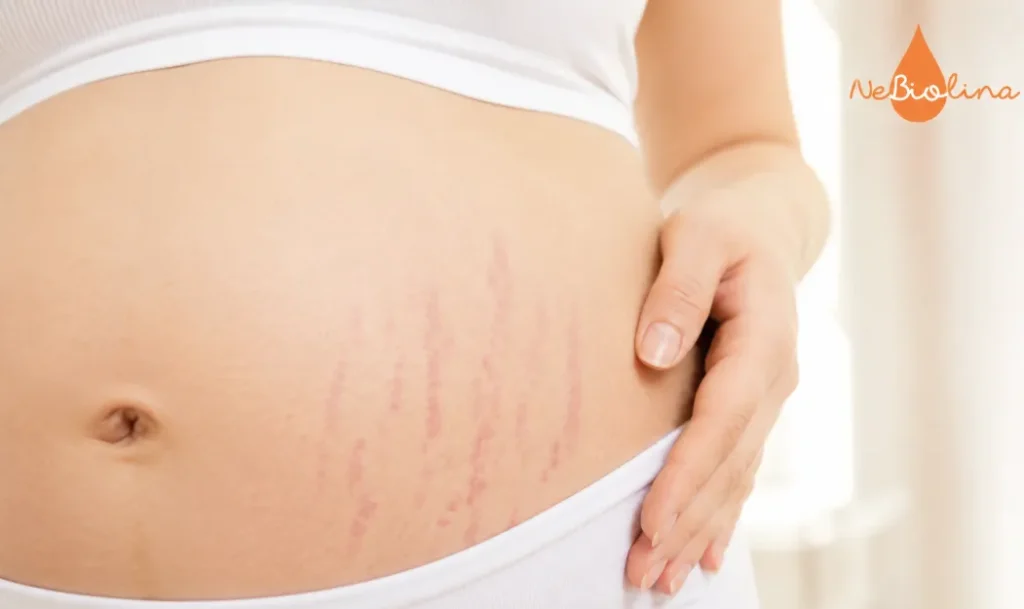 Rạn da đỏ là những đường rạn mới hình thành trên bề mặt da.