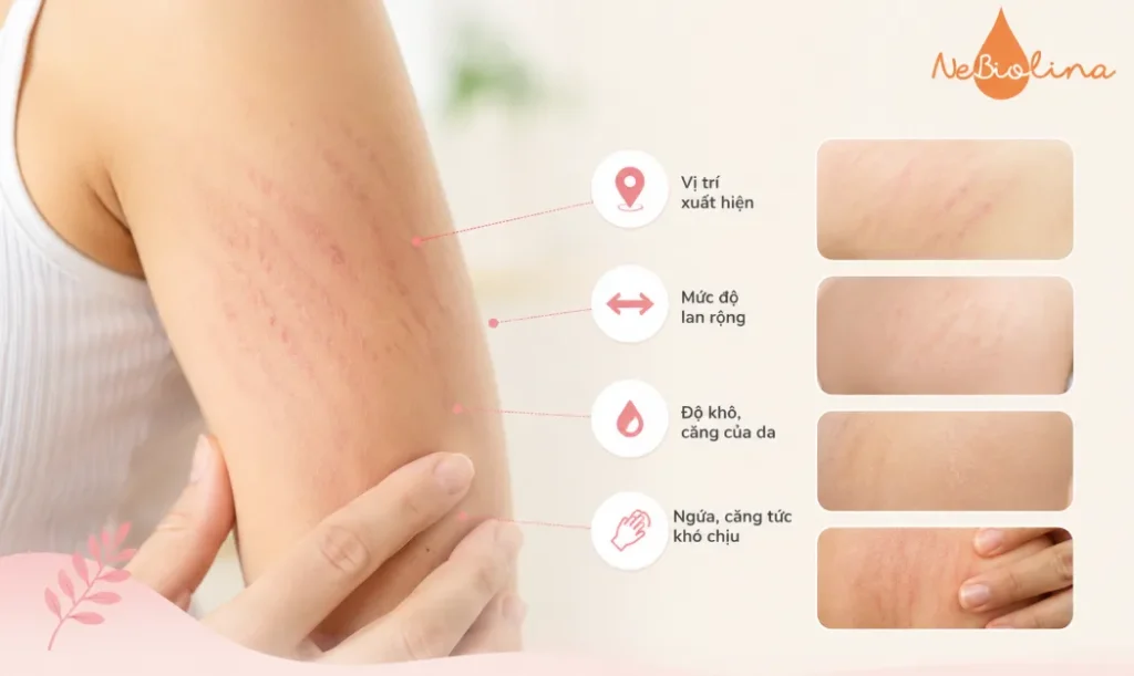 Bước đầu cần theo dõi tần suất xuất hiện và mức độ lan rộng của các vết rạn