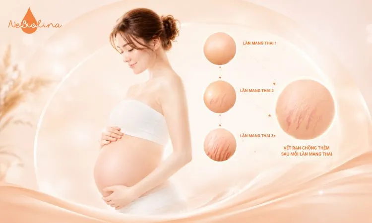 rạn da sau sinh có tự hết không (4)_4