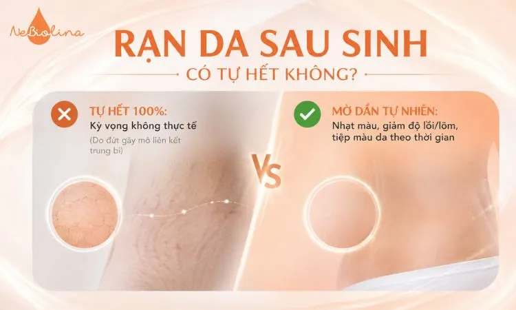 Rạn da sau sinh có tự hết không?