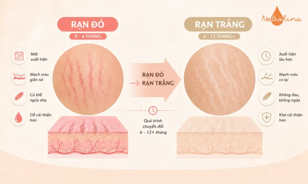 Phân biệt rạn da đỏ và rạn da trắng
