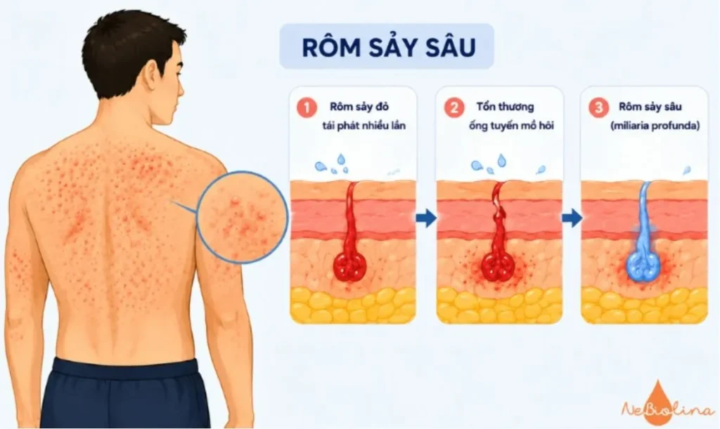 Rôm sảy sâu thường xuất hiện ở người lớn.