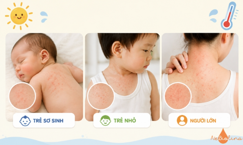 Rôm sảy có thể xuất hiện ở mọi lứa tuổi.