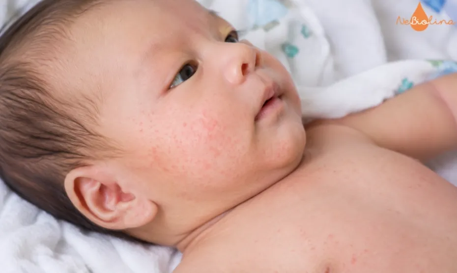 Rôm sảy xuất hiện phổ biến ở trẻ sơ sinh.