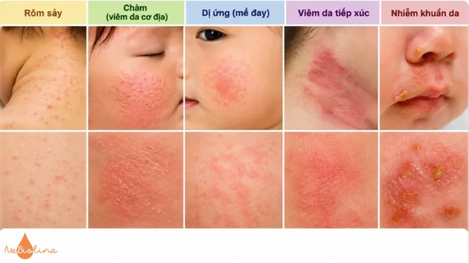 Rôm sảy dễ bị nhầm lẫn với nhiều tình trạng da liễu khác.