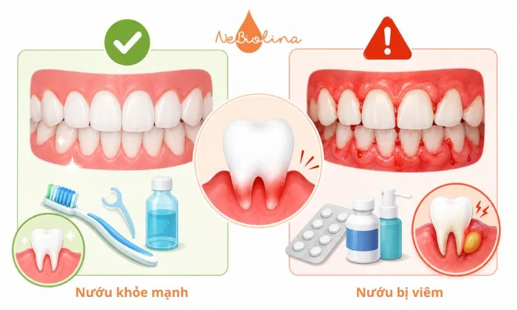 Hình ảnh nướu khỏe mạnh và nướu bị viêm