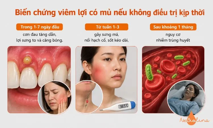 Viêm lợi có mủ có thể lan rộng và gây nhiều biến chứng nếu chậm điều trị.