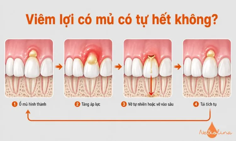 Sơ đồ vòng lặp khiến ổ mủ ở lợi tái phát và ngày càng nghiêm trọng hơn.