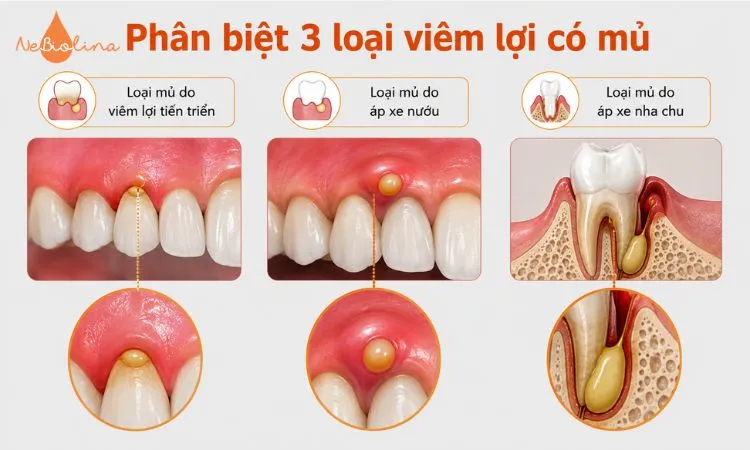 Sự khác nhau giữa mủ do viêm lợi tiến triển, áp xe nướu và áp xe nha chu.
