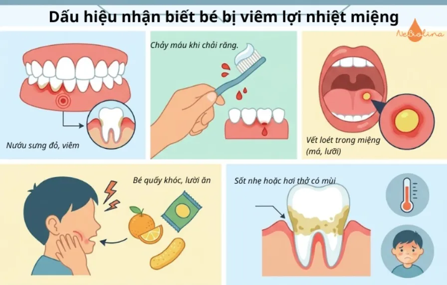 Những dấu hiệu nhận biết viêm lợi nhiệt miệng