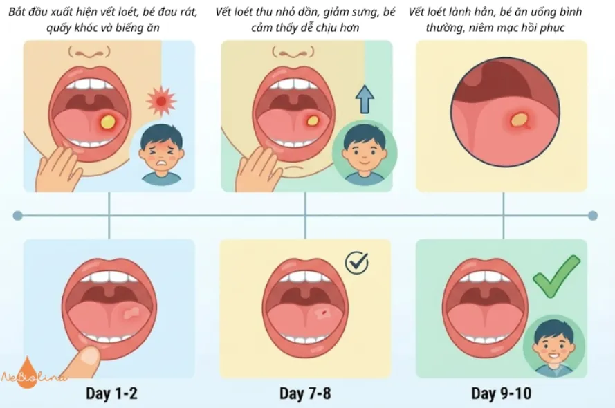 Quá trình tiến triển nhiệt miệng