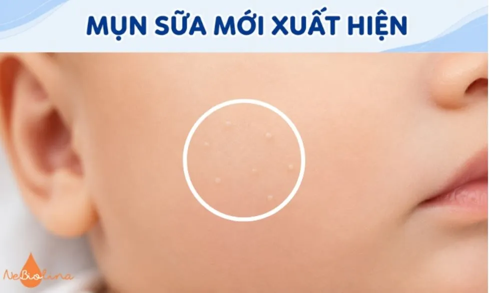 Các nốt mụn sữa màu trắng nhỏ mới nổi.