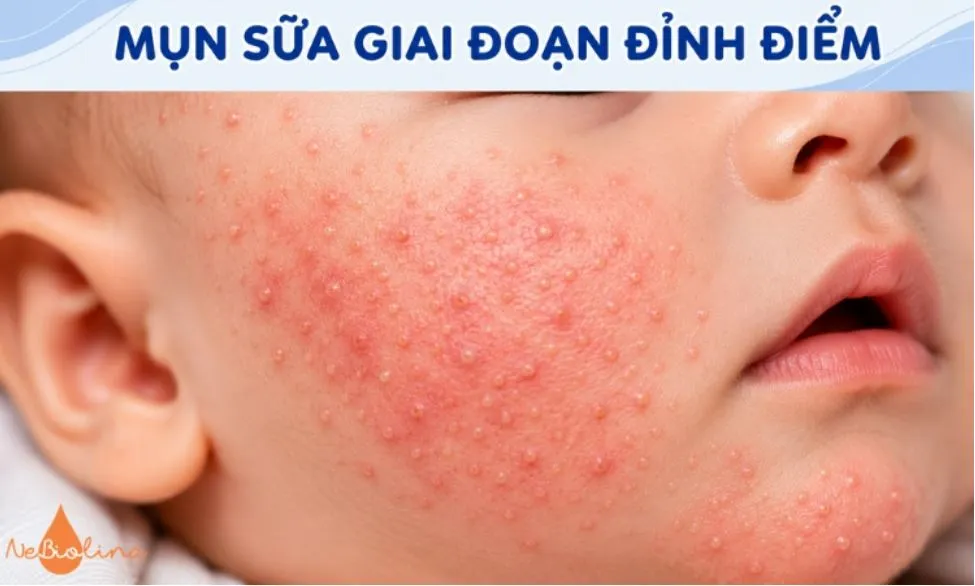 Mụn sữa mọc thành cụm dày, lan rộng hơn.