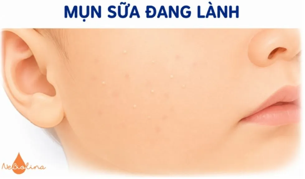 Mụn sữa nhạt hơn và xẹp dần.