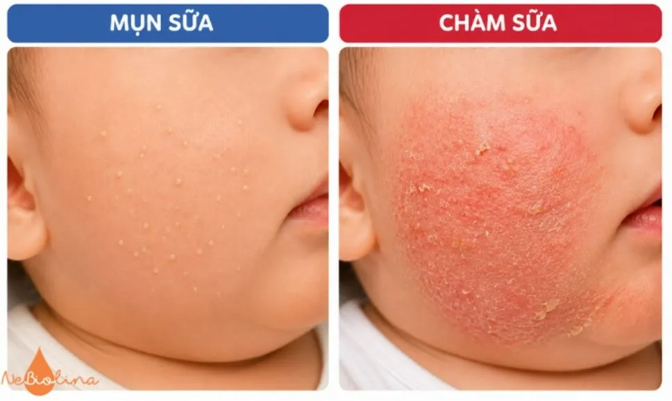 Sự khác nhau giữa mụn sữa và chàm sữa.