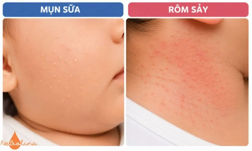 Sự khác nhau giữa mụn sữa và rôm sảy.