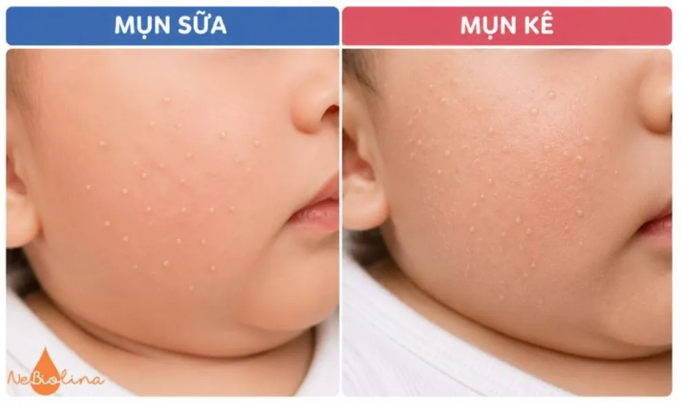 Sự khác nhau giữa mụn sữa và mụn kê.