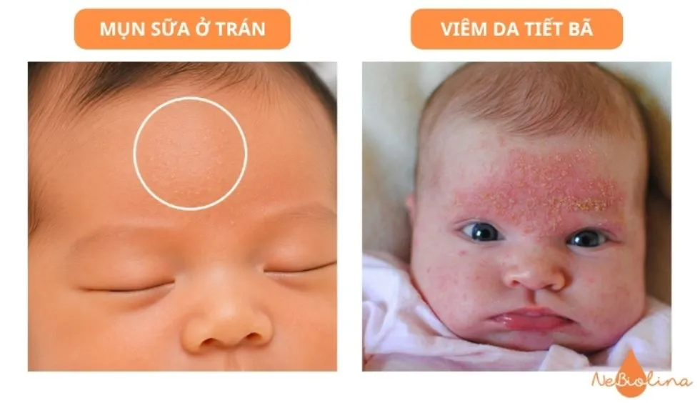 Mụn sữa ở trán - chú ý: nếu có vảy vàng kèm theo, cần phân biệt với viêm da tiết bã.