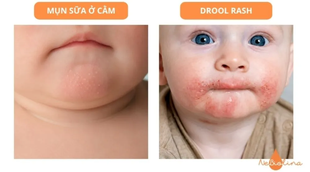 Mụn sữa và drool rash - đỏ hơn, viền lan theo nước bọt.