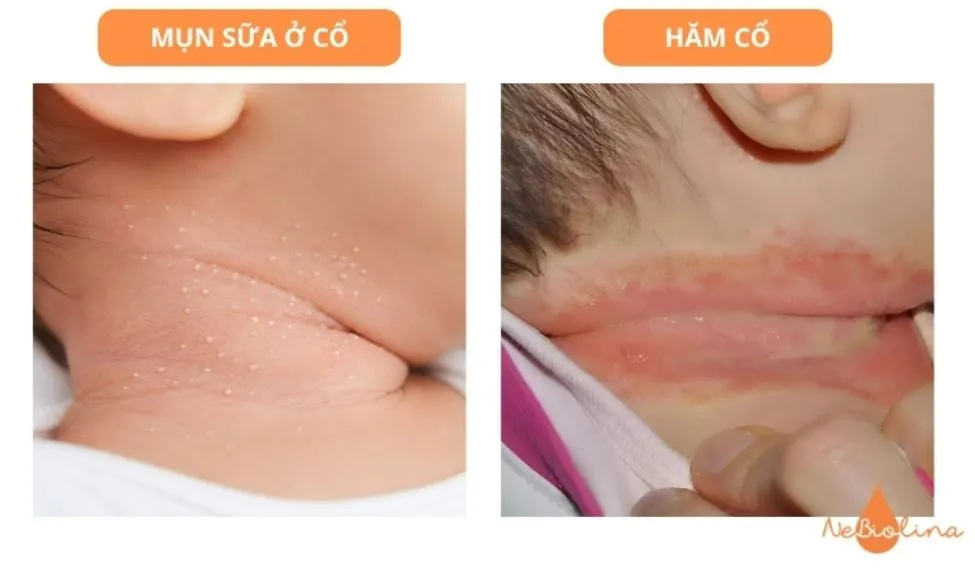 Nốt trắng ở nếp cổ - phân biệt với hăm: hăm có mùi và da ướt hơn.