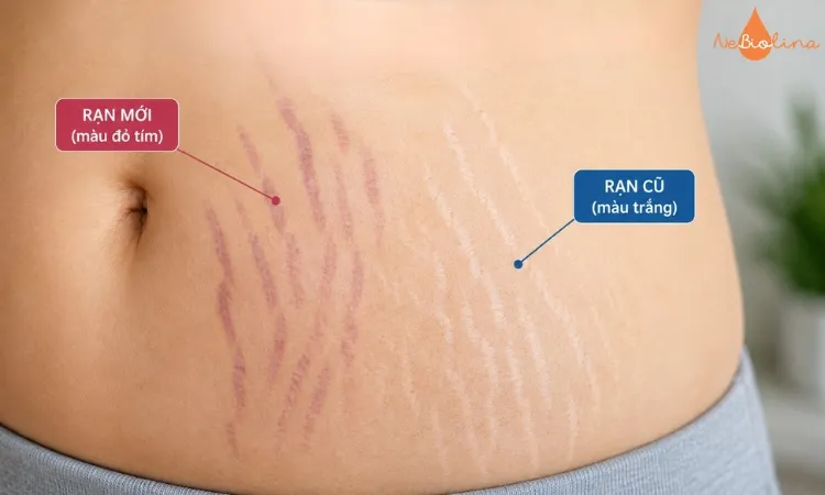 Phân biệt vết rạn cũ và mới để đánh giá sự thay đổi của làn da theo thời gian.