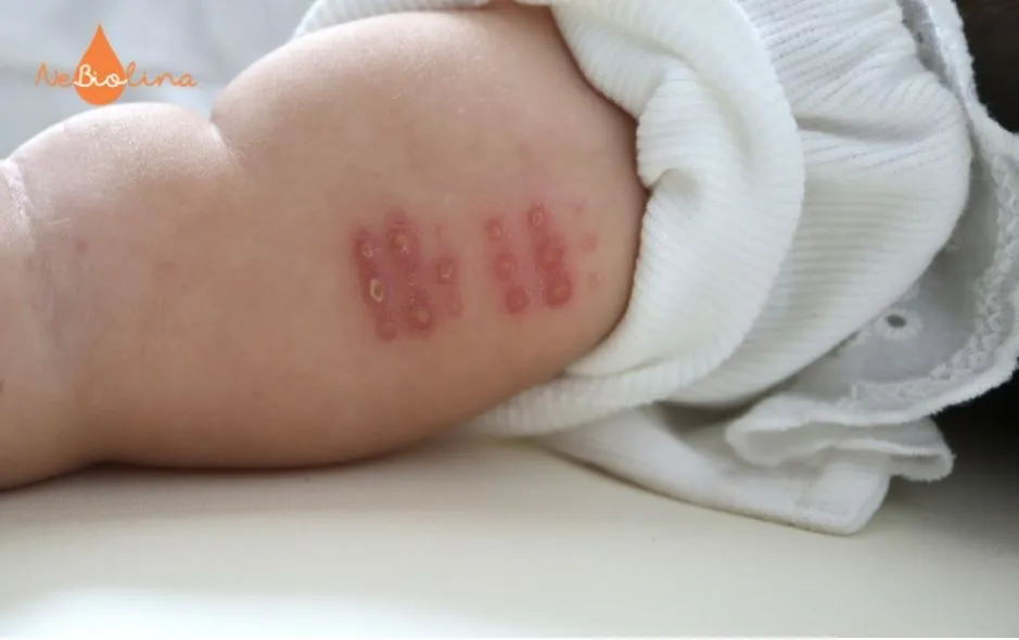 Mụn sữa chỉ để lại sẹo khi bị nặn hoặc chà xát